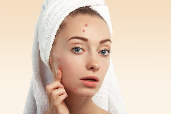 Pimple Kaise Thik Kare