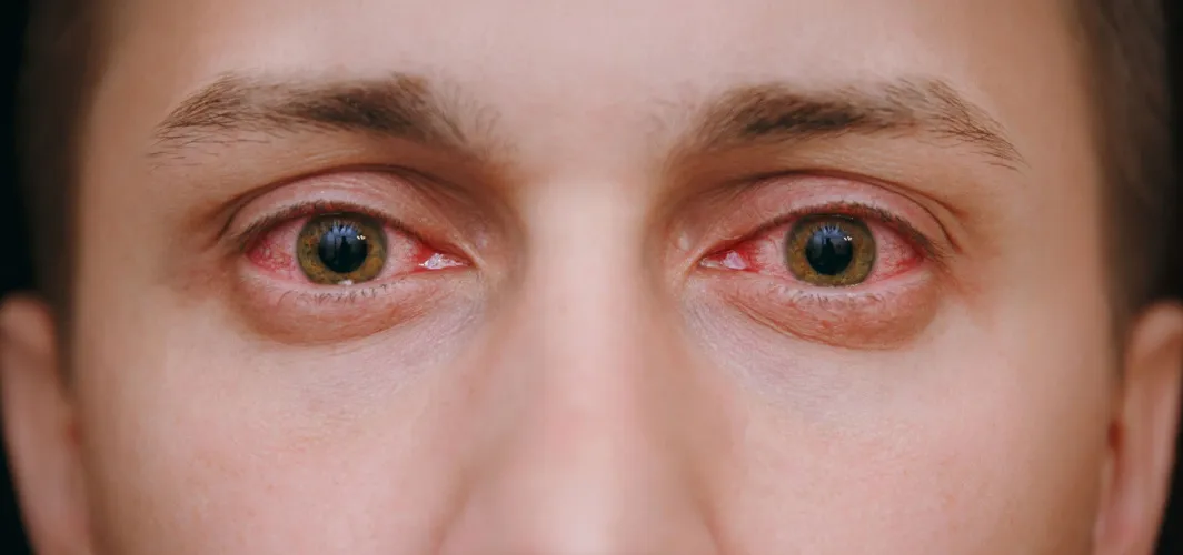 Eye Flu 